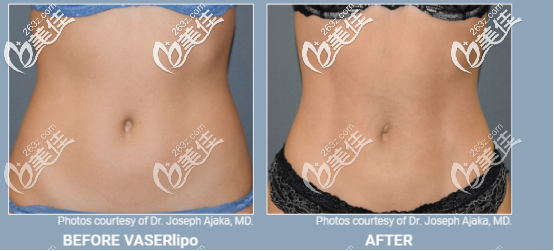 威塑超聲吸脂女性案例