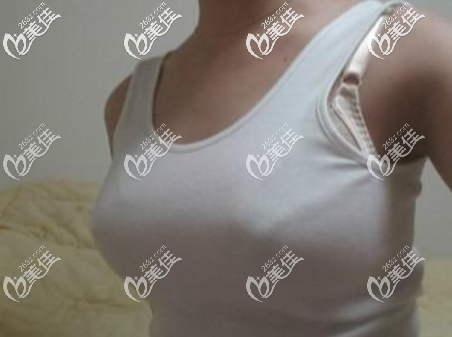 做曼托毛面500cc假體隆胸一年后效果圖 做曼托毛面500cc假體隆胸一年后效果圖