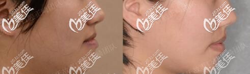 溫州愛(ài)牙故事牙科隱適美正畸案例 溫州愛(ài)牙故事牙科隱適美正畸案例