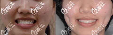 溫州愛(ài)牙故事地包天牙齒矯正真人案例 溫州愛(ài)牙故事地包天牙齒矯正真人案例