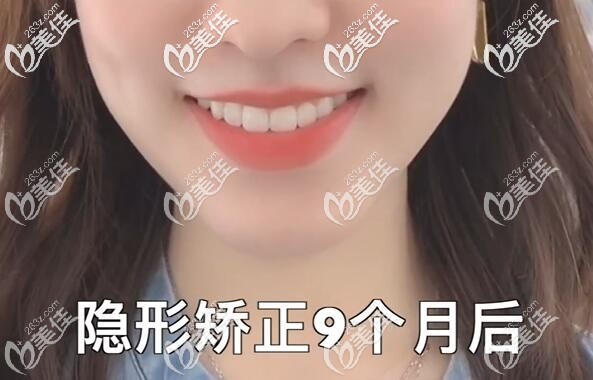 隱形矯正9個(gè)月后 隱形矯正9個(gè)月后