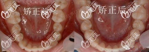 溫州愛(ài)牙故事牙齒矯正真人案例 溫州愛(ài)牙故事牙齒矯正真人案例