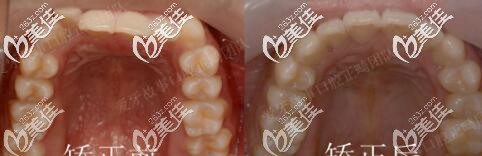 溫州愛(ài)牙故事口腔門(mén)診部正畸真人案例 溫州愛(ài)牙故事口腔門(mén)診部正畸真人案例