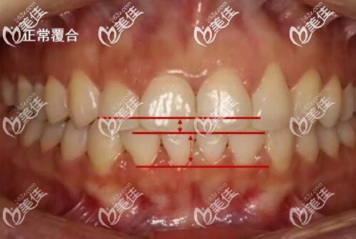 牙齒正常咬合圖 牙齒正常咬合圖