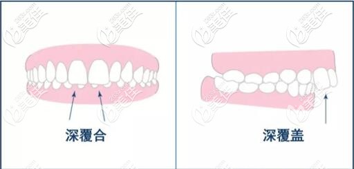深覆合和深覆蓋區(qū)別圖片 深覆合和深覆蓋區(qū)別圖片