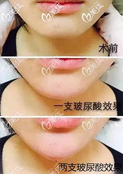 打一支玻尿酸和兩支的區(qū)別 打一支玻尿酸和兩支的區(qū)別