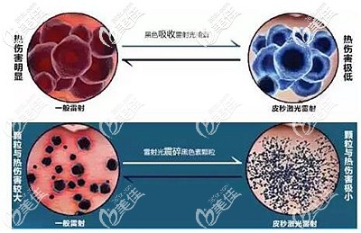 皮秒激光祛斑的優(yōu)勢 皮秒激光祛斑的優(yōu)勢
