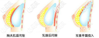 雙平面假體隆胸植入層次示意圖 雙平面假體隆胸植入層次示意圖