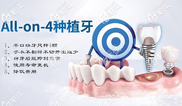 美奧口腔allon4半口全口種植牙技術(shù)