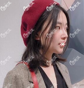 在泰國(guó)隆鼻術(shù)后2個(gè)月 在泰國(guó)隆鼻術(shù)后2個(gè)月