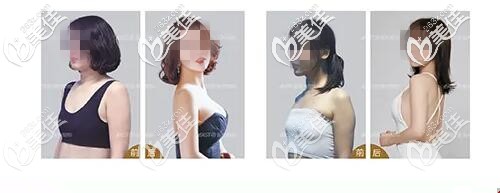 極速豐胸真人案例 極速豐胸真人案例