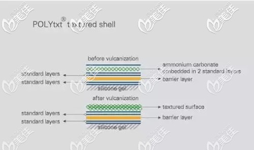 德國(guó)寶儷假體隆胸優(yōu)勢(shì)