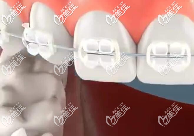 陶瓷半隱形牙套