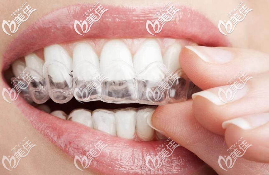 無托槽隱形牙套