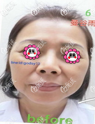 我做面部拉皮前樣子 我做面部拉皮前樣子