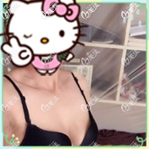 術(shù)前的自己算是胸部有料 術(shù)前的自己算是胸部有料