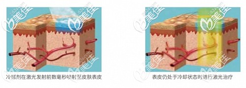 染料激光去紅血絲的原理 染料激光去紅血絲的原理