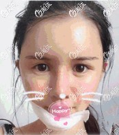 假體墊下巴術(shù)后拆線