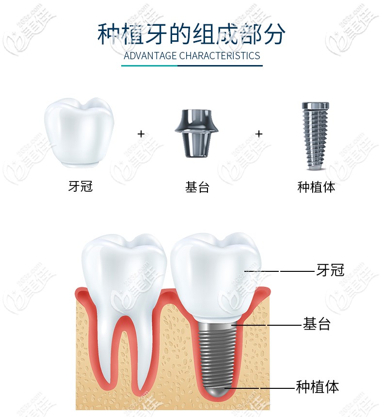 iti種植體結(jié)構(gòu)組成部分 iti種植體結(jié)構(gòu)組成部分