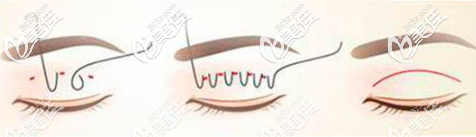 原生雙眼皮手術(shù)過程示意圖 原生雙眼皮手術(shù)過程示意圖