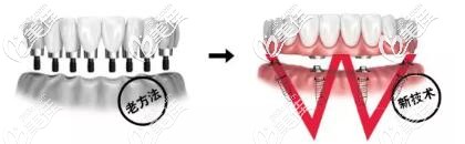 半口種植牙和傳統(tǒng)種植牙區(qū)別 半口種植牙和傳統(tǒng)種植牙區(qū)別