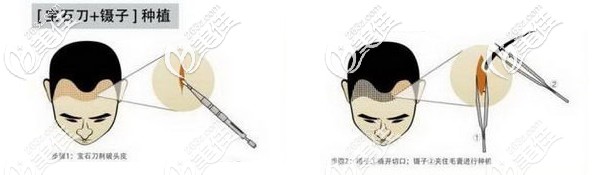 fue無(wú)痕植發(fā)技術(shù)手術(shù)過(guò)程