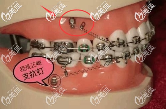正畸支抗釘示意圖