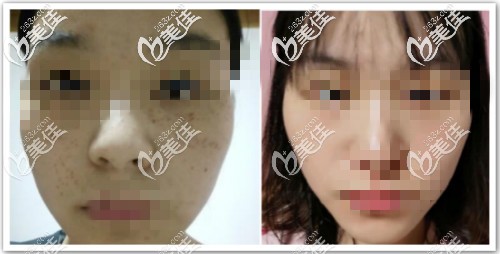 皮秒祛斑3次效果對比圖