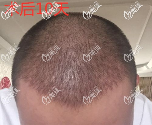 加密植發(fā)10后長出了新發(fā)茬 加密植發(fā)10后長出了新發(fā)茬