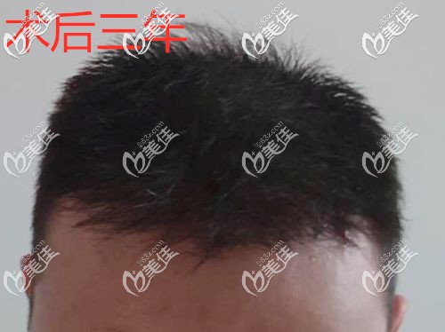 用我的真實(shí)加密植發(fā)經(jīng)歷告訴你：植的頭發(fā)兩年就掉了的情況并不是人人都有