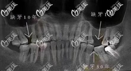 牙齒缺失鄰牙傾倒 牙齒缺失鄰牙傾倒