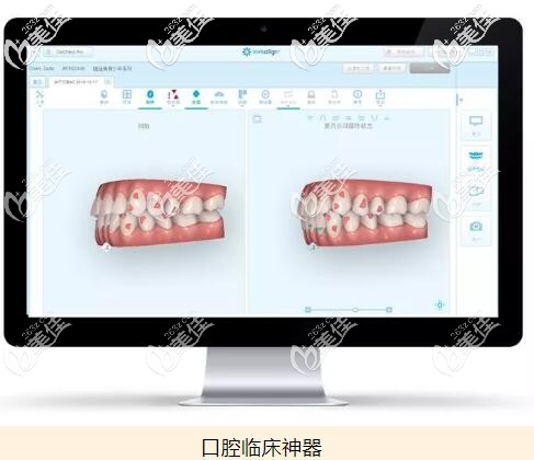 iTero口掃儀 iTero口掃儀