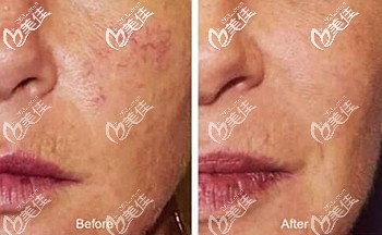 激光去紅血絲效果前后對(duì)比 激光去紅血絲效果前后對(duì)比