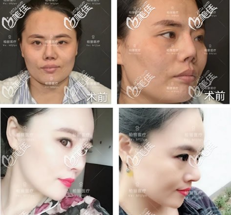 北京柏麗李勁良鼻修復(fù)案例 北京柏麗李勁良鼻修復(fù)案例