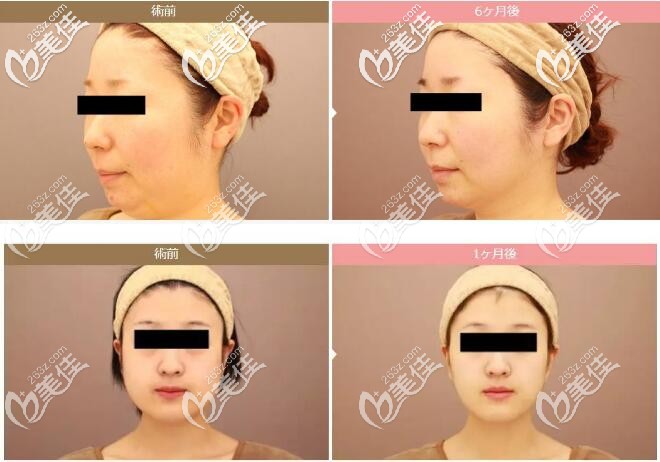 面部吸脂對比案例