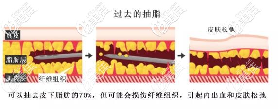 傳統(tǒng)的抽脂方法可以去除約70%的皮下脂肪