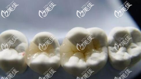 嵌體補(bǔ)牙