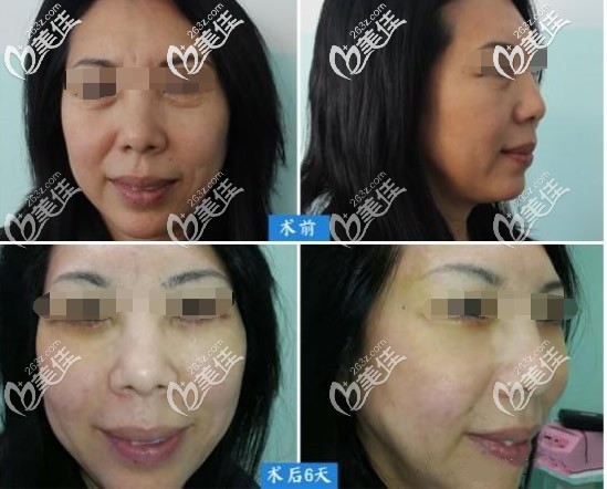 真人外切眼袋加面中部提升前后對(duì)比照片 真人外切眼袋加面中部提升前后對(duì)比照片