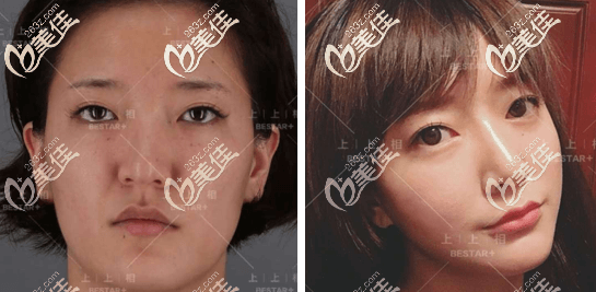 北京上上相全面部脂肪填充案例