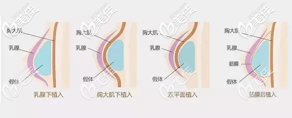 隆胸假體放置的位置 隆胸假體放置的位置