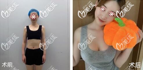 杭州隆胸好的醫(yī)院格萊美案例 杭州隆胸好的醫(yī)院格萊美案例