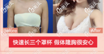 北京藝星醫(yī)療美容醫(yī)院假體隆胸案例 北京藝星醫(yī)療美容醫(yī)院假體隆胸案例