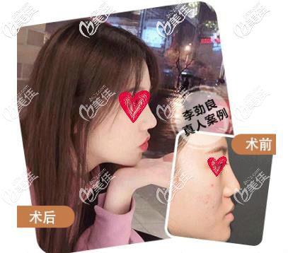 李勁良醫(yī)生鼻修復(fù)案例 李勁良醫(yī)生鼻修復(fù)案例