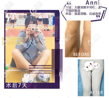 北京雅靚多維立體吸脂案例