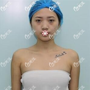 我術(shù)前的胸 我術(shù)前的胸