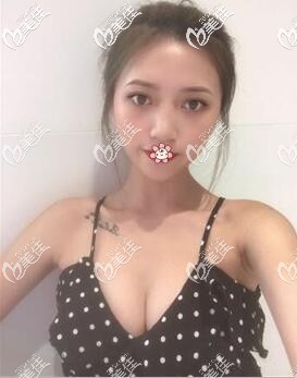 我在泰國藝術(shù)整形做完隆胸手術(shù)20天了 我在泰國藝術(shù)整形做完隆胸手術(shù)20天了