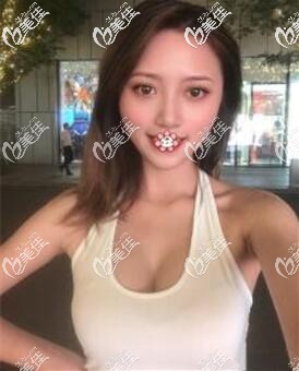 泰國藝術(shù)整形外科傲諾拉假體隆胸3個(gè)月 泰國藝術(shù)整形外科傲諾拉假體隆胸3個(gè)月