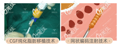 北京潤(rùn)美玉之光王明利脂肪移植技術(shù)手術(shù)示意圖