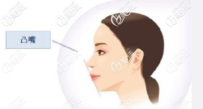 凸嘴改善方法詳解