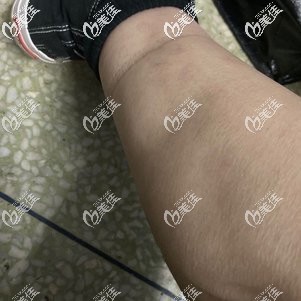 大小腿吸脂前的腿部贅肉 大小腿吸脂前的腿部贅肉